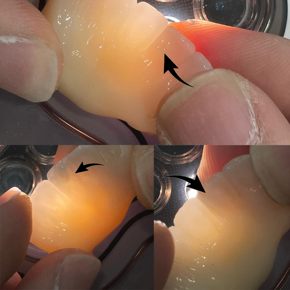 Treatment of tooth fracture and deformation during machining